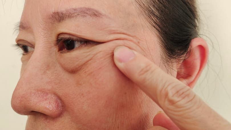 Ptosis de cejas - Cirugía Parpados en Santander