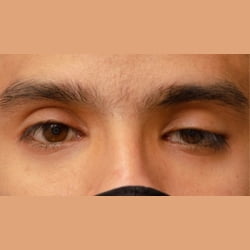 Ptosis palpebral - Cirugía Parpados en Santander